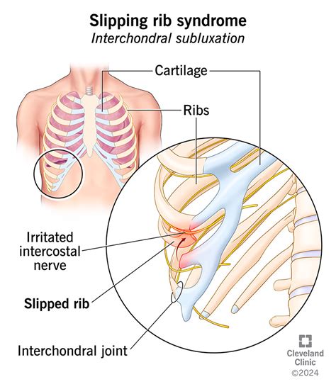 How To Stop Slipping Rib