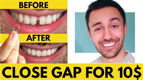 how to straighten your teeth at home with rubber bands