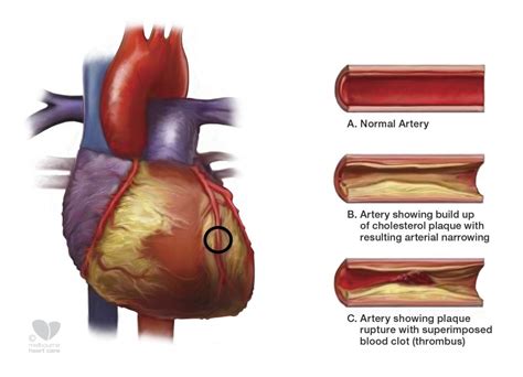 How To Strengthen Your Coronary Arteries For A Healthier Heart