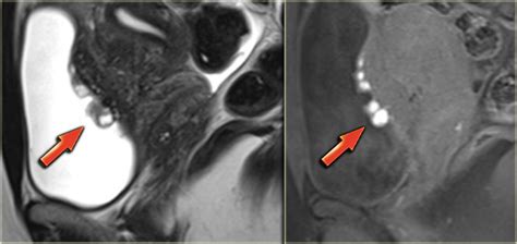 how to test for endometriosis with mri