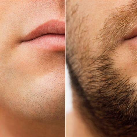How To Thicken Beard Follicles