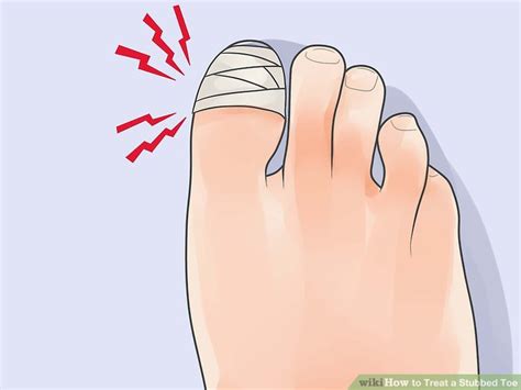 how to treat a badly stubbed toe