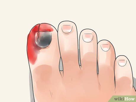how to treat a stubbed toe nail