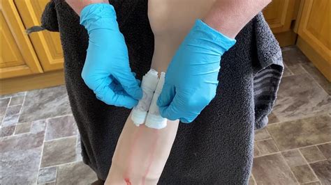 how to treat a wound with an embedded object