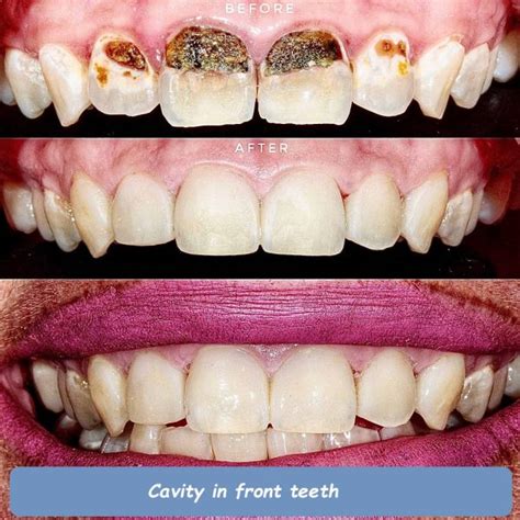 how to treat cavity in front teeth