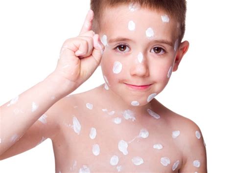 how to treat chicken pox scar
