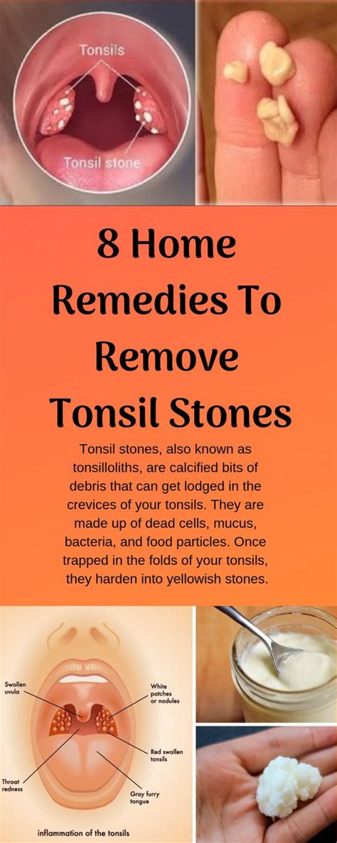 how to treat chronic tonsil stone