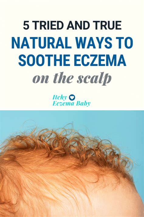 how to treat eczema on scalp toddler