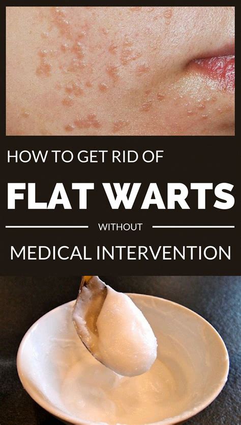 how to treat flat warts