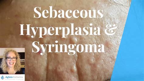 how to treat sebaceous hyperplasia at home