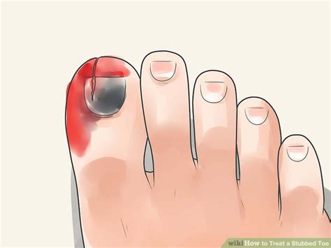 how to treat stubbed little toe