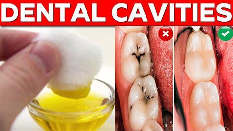 how to treat tooth cavity at home