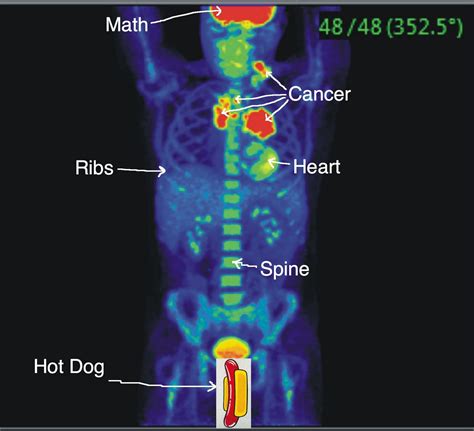 how to understand pet scan results