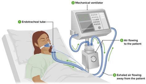 How To Use A Mechanical Ventilator