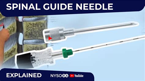 How To Use A Spinal Needle