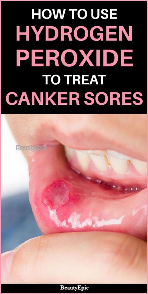 how to use hydrogen peroxide to heal canker sore