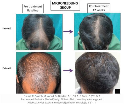 how to use minoxidil and microneedling