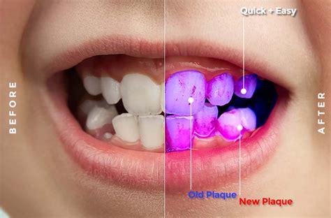 how to use plaque disclosing solution