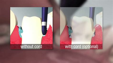 How To Use Retraction Paste