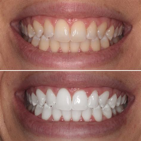 Are AtHome Teeth Whitening Kits Safe/Good? Mona Vale Dental