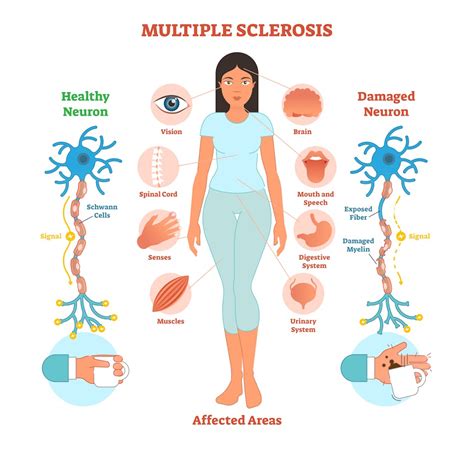 How Will Multiple Sclerosis Affect Other Body Tissues