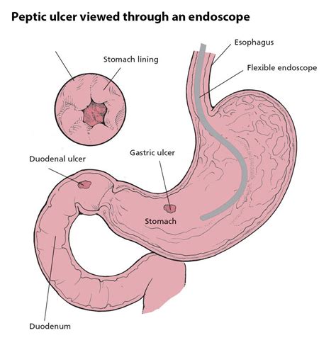How do stomach ulcers develop?