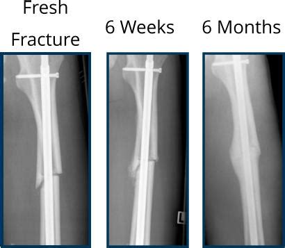 Figure 1 from Clinical Efficacy of the Microfracture Technique for Articular Cartilage Repair in