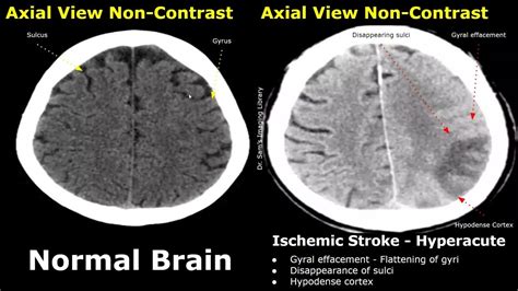 CT Scan What It Is, Types, Purpose, Procedure Results, 49 OFF