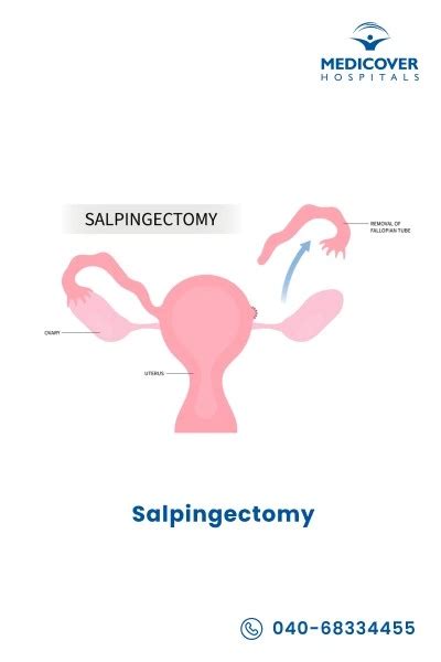 How to code salpingostomy?