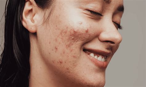 Redness the redness of a pimple AND reduce its lifespan with these easy tips! Redness On Face