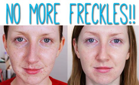 How to Easily REMOVE FRECKLES from the Face or Skin in (3 Minutes) YouTube