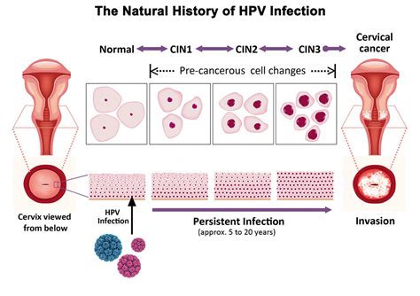 hpv 16 18 risk of cervical cancer