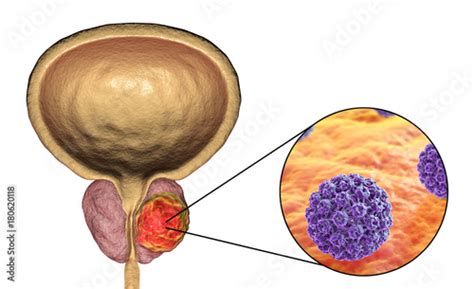 hpv and prostate cancer