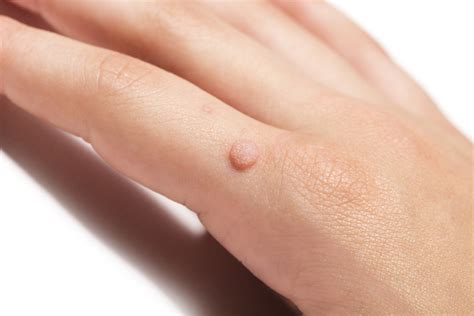 hpv cause warts on hands