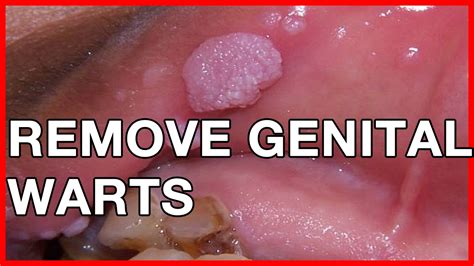 hpv genital warts male