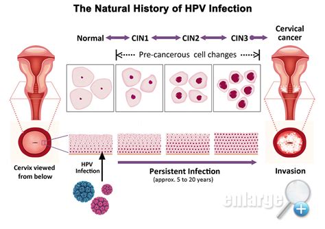hpv linked to cervical cancer