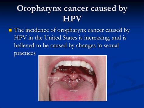 hpv oropharyngeal cancer symptoms