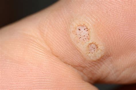 hpv that causes plantar warts