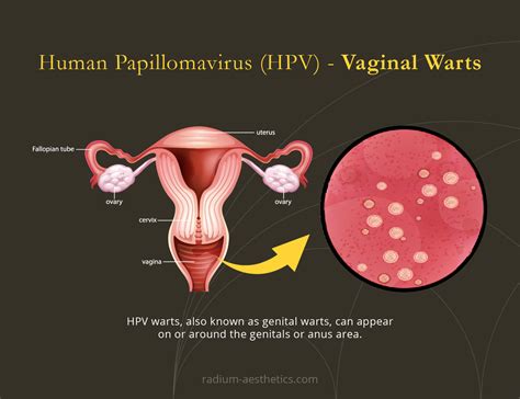 hpv tumors