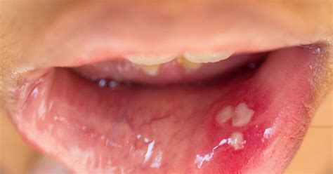 hpv warts in mouth contagious