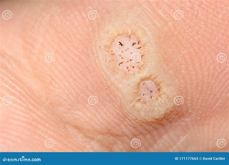 hpv warts on foot