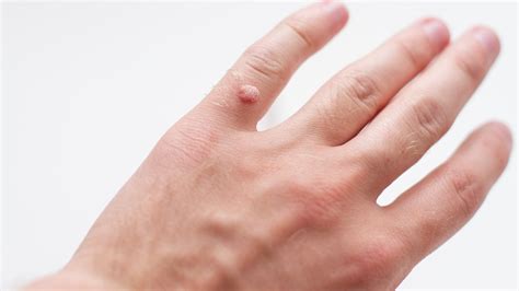 hpv warts on hands