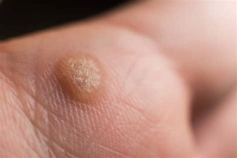 hpv warts on hands treatment