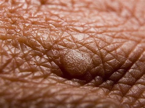 hpv warts on skin