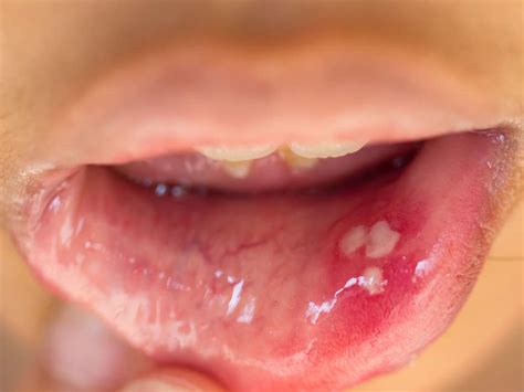 hpv warts pics men