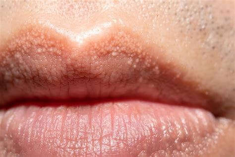 hpv white spots on lips pictures