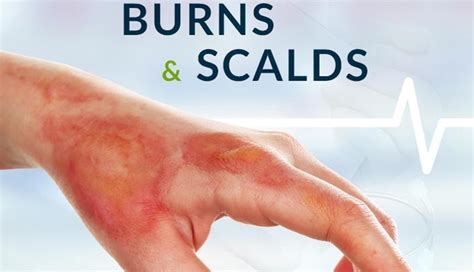 hse burns and scalds