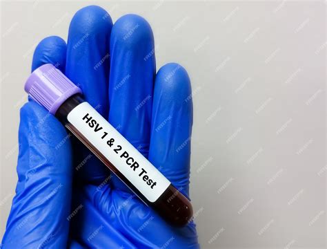 hsv 1 and 2 pcr blood