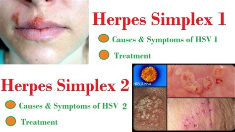 hsv 1 and hsv 2 symptoms