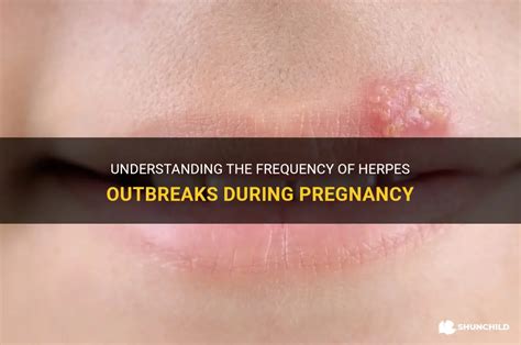 hsv 1 outbreak during pregnancy